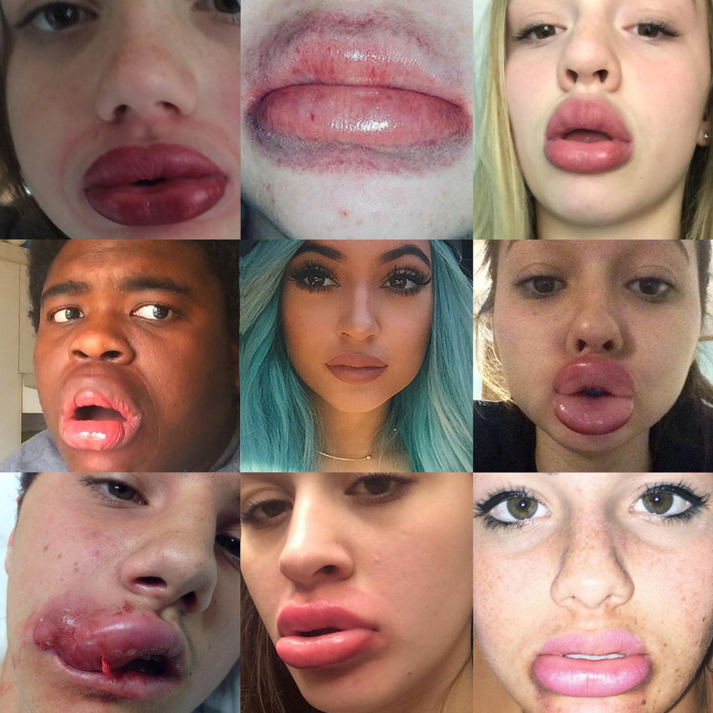 Kylie jenner lip challenge ishowspeed